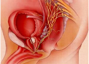 Καρκίνος του προστάτη: Η σημασία της πρόληψης και οι νέες θεραπευτικές μέθοδοι